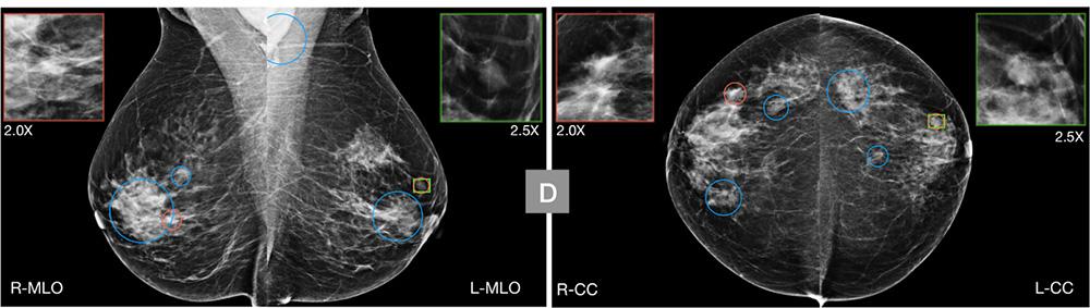 A radiologist judged this digital mammogram as inconclusive, leading to a unnecessary biopsy. In a study, an AI deemed the scan to be "nonsuspicious" and could have prevented the unnecessary care. 