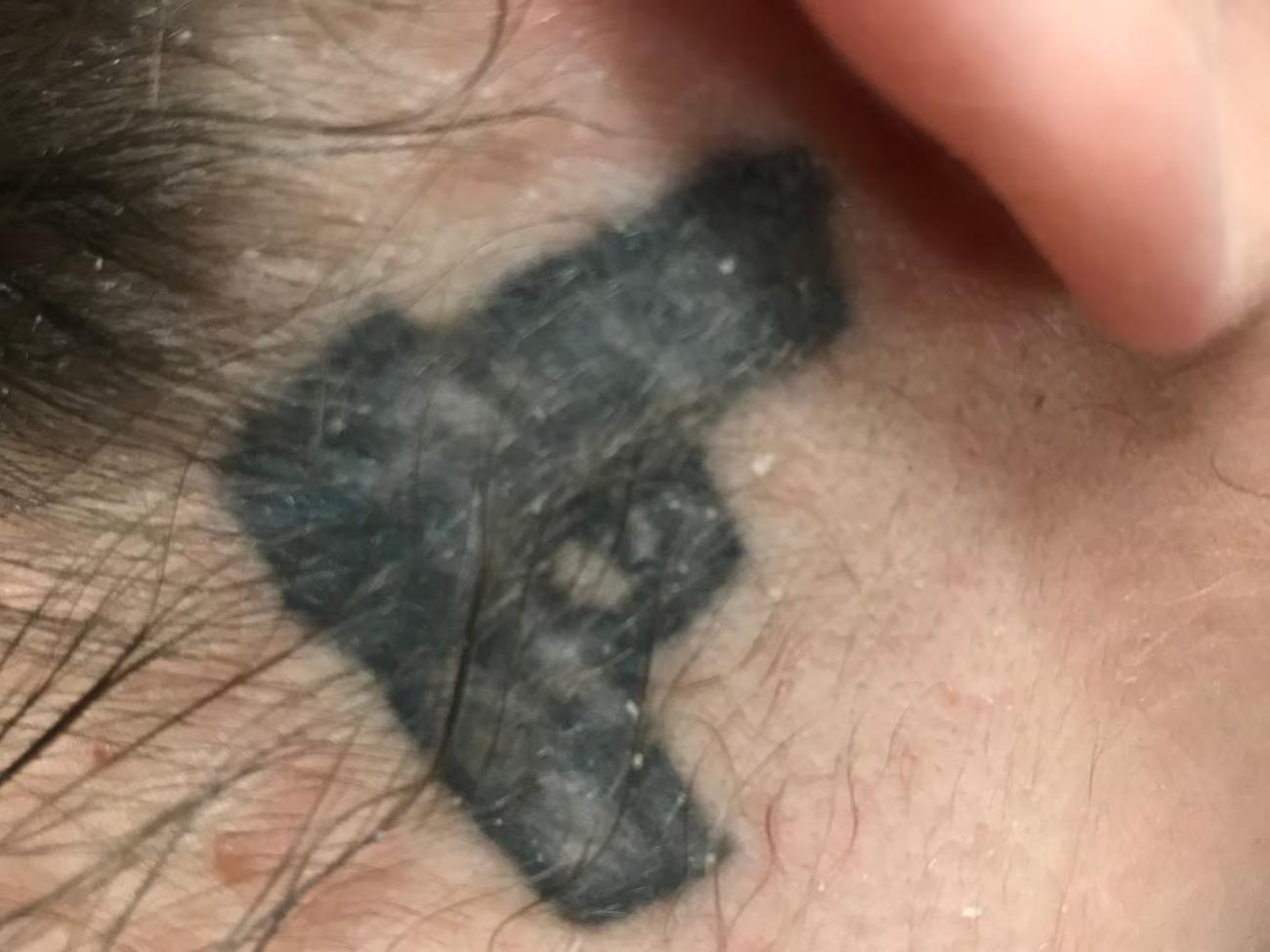 At the Harvard pro bono tattoo removal program, Shadi Kourosh, MD, MPH, removed this branding tattoo from a young woman who is a human trafficking survivor.