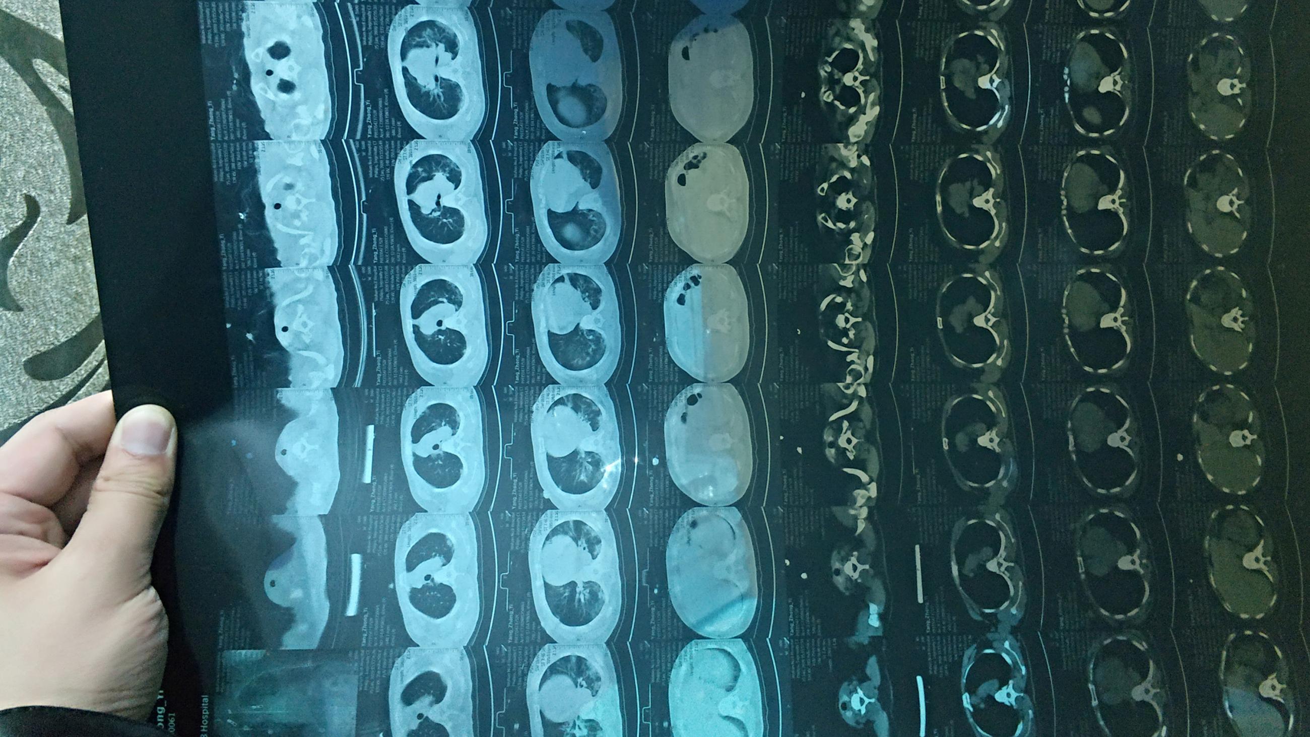 The photo shows a hand holding a blue-tinted piece of X-ray film with lots of images of sections of lung scanned by the CT instrument. 