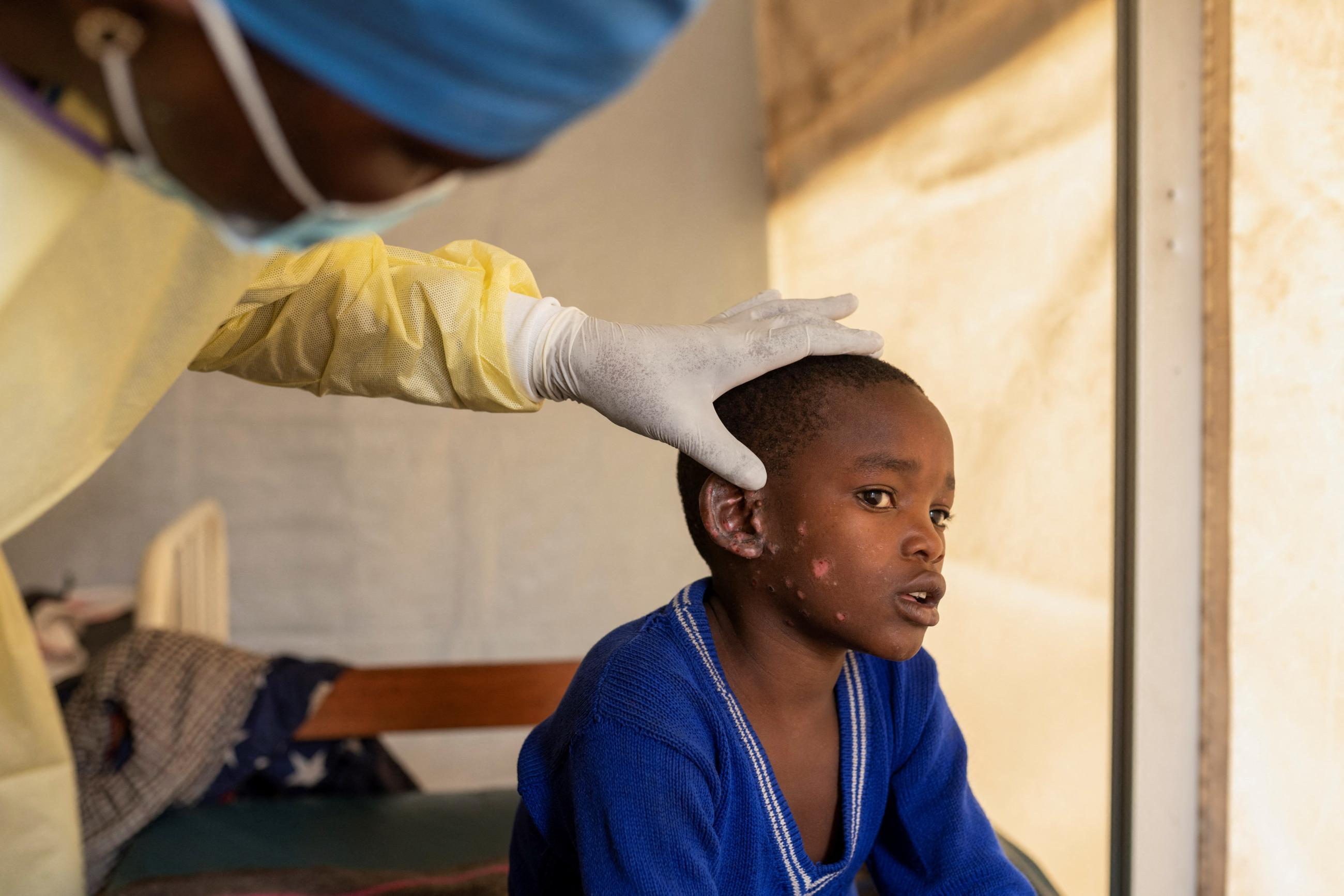 A doctor checks the evolution of skin lesions on the ear of a child suffering from mpox.