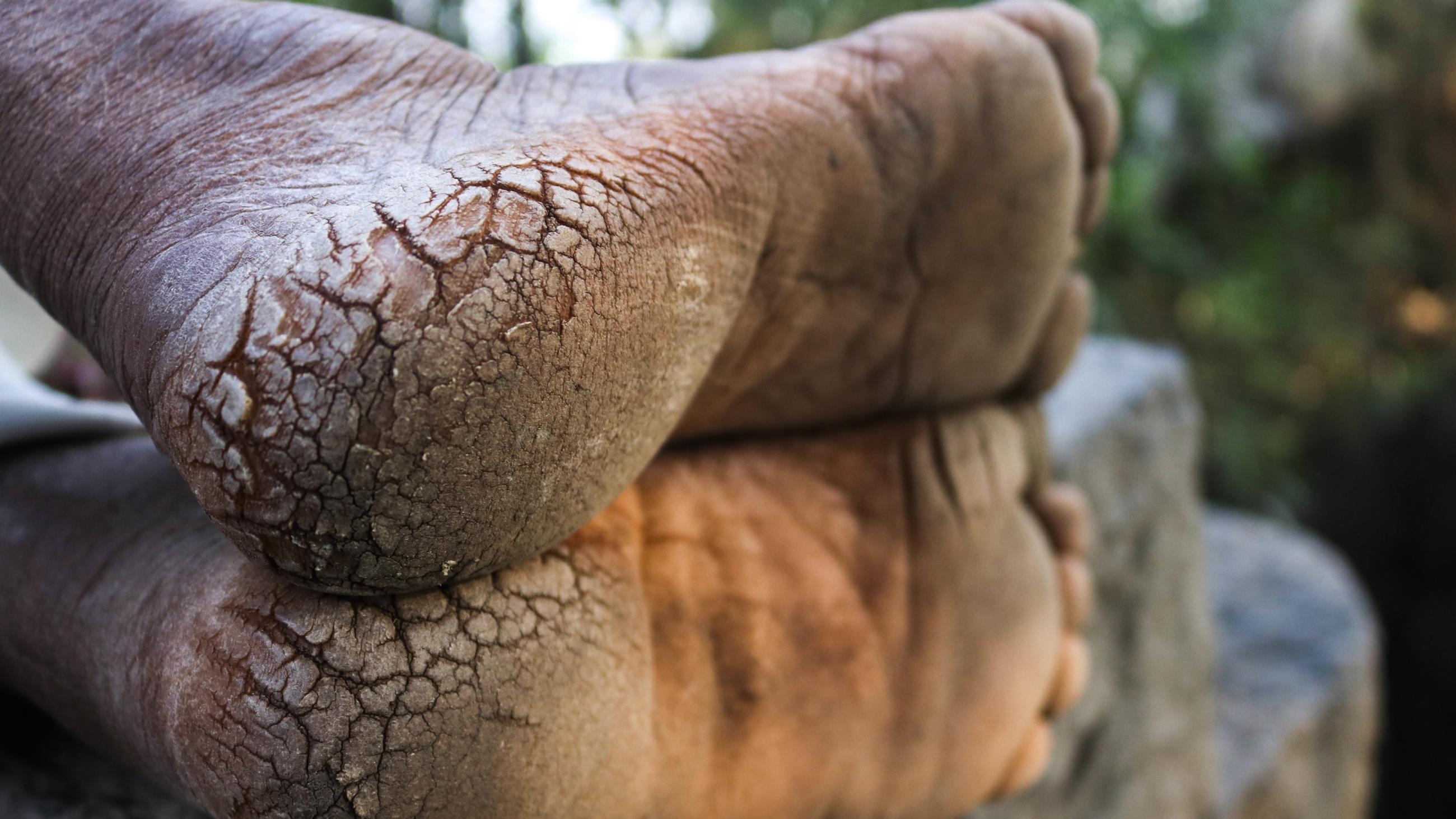 A worker's feet are shown with cracked heels.