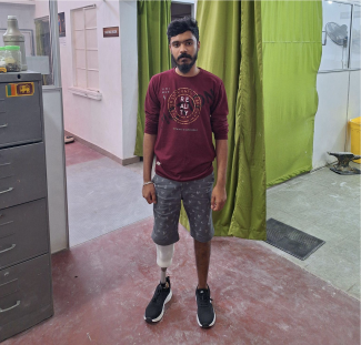 Kishan Kumar received a prosthetic leg made with recycled materials and a 3D-printed socket after months of searching.